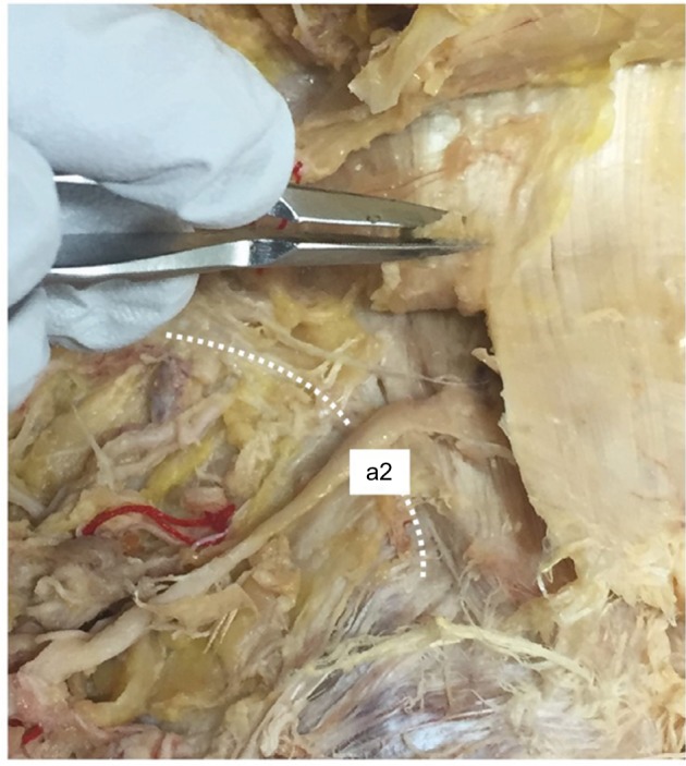 La etiología anatómica de la «pseudo-ciática» del atrapamiento del nervio cluneal superior